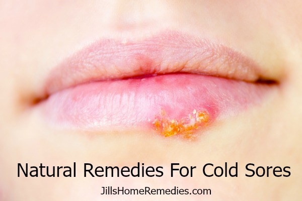 Natural Remedies For Cold Sores